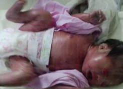 11周试管妊娠，何时可停用保胎药及减量建议？